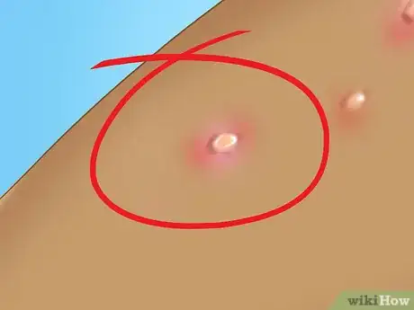 Image titled Recognize Molluscum (Molluscum Contagiosum) Step 4