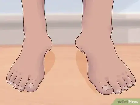 Image titled Recognize and Prevent Lymphatic Filariasis Step 1