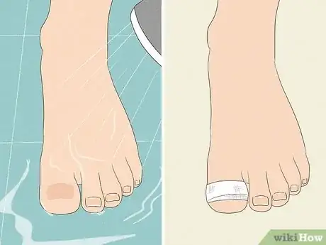 Image titled Remove a Dead Toenail Step 12