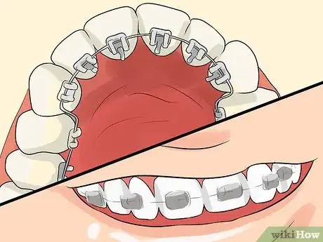 Image titled Prepare on the Day You Get Braces Step 2