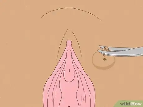 Image titled Recognize Vulva Cancer Symptoms Step 12