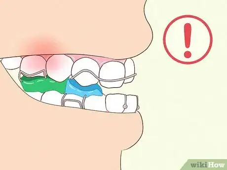 Image titled Cope with Twin Block Braces Step 13
