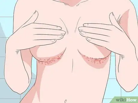 Image titled Get Rid of a Rash Under Breasts Step 6