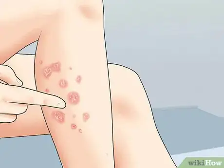 Image titled Diagnose Psoriasis Step 2