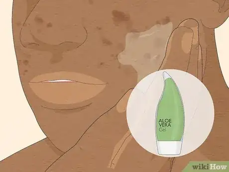 Image titled Get Rid of Cystic Acne Scars Step 3