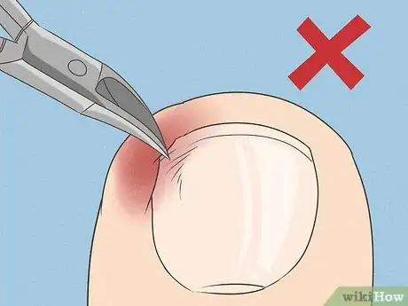 Image titled Will an Ingrown Toenail Heal Itself Step 7