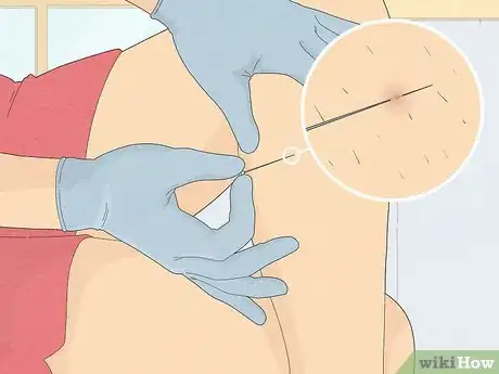 Image titled Remove an Ingrown Hair Under the Skin Step 8