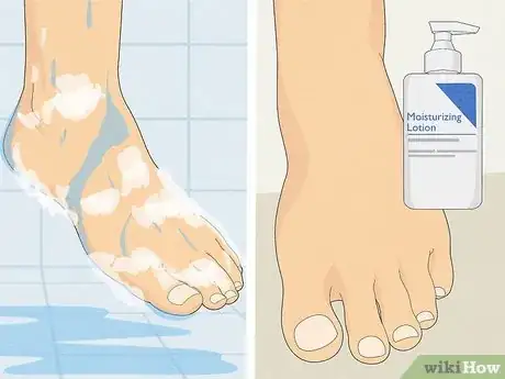 Image titled Treat Toe Nail Fungus Step 15