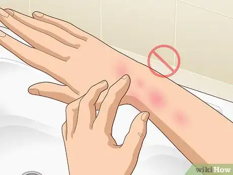 Image titled Get Rid of Poison Oak Rash Step 1