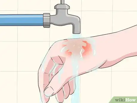 Image titled Prevent Burn Scars Step 1