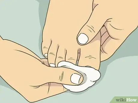 Image titled Soak an Ingrown Toenail Step 6