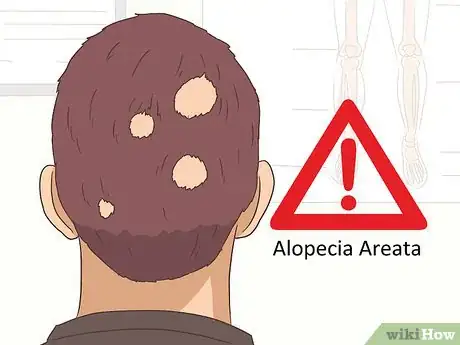 Image titled Treat Alopecia Step 12