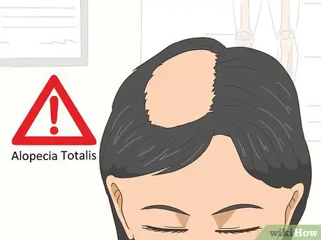 Image titled Treat Alopecia Step 13