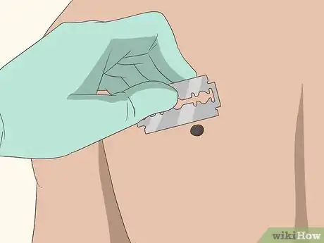 Image titled Remove Birthmarks Step 5