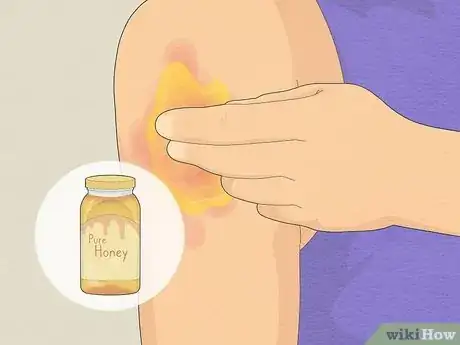 Image titled Use Aloe Vera to Treat Burns Step 9