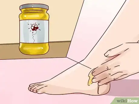 Image titled Get Rid of Ringworm Scars Step 5