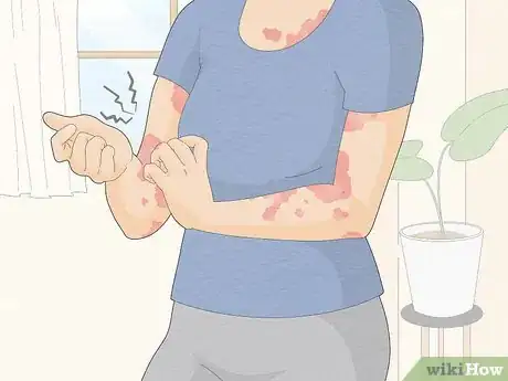 Image titled Use Apple Cider Vinegar for Psoriasis Step 2