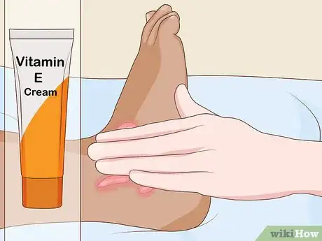 Image titled Get Rid of Keloids Step 12