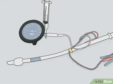 Image titled Measure an ET Tube Step 14