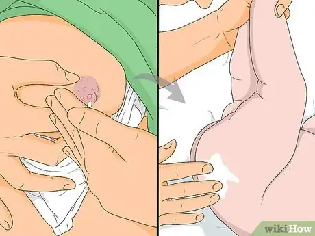 Image titled Relieve Diaper Rash Fast Step 10