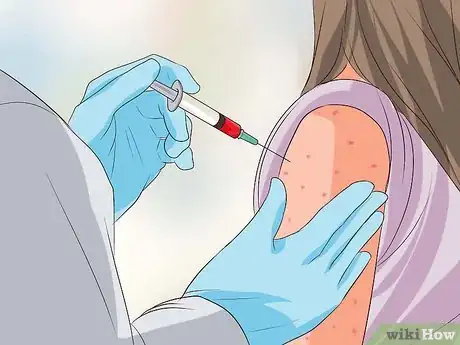 Image titled Recognize Chickenpox Step 14