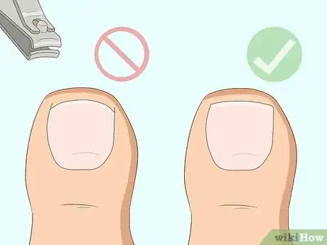 Image titled Relieve Ingrown Toe Nail Pain Step 27