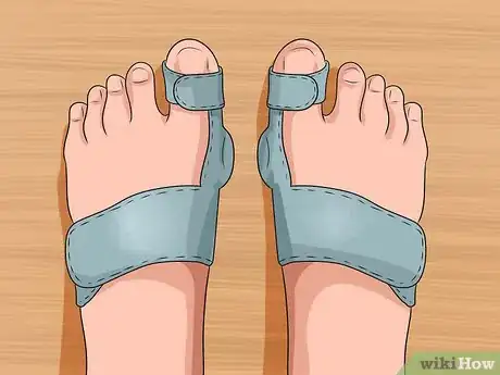 Image titled Get Rid of Bunions Step 8