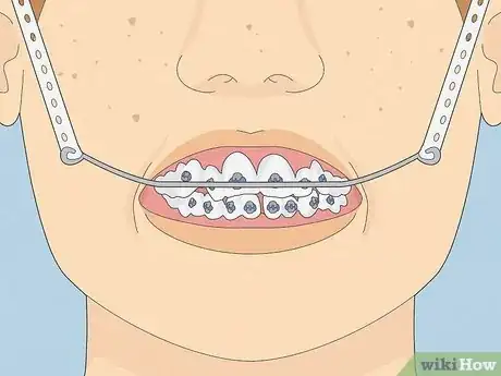 Image titled Straighten Your Teeth Without Braces Step 18