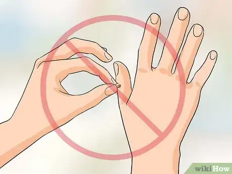 Image titled Get Rid of Warts on Fingers Step 10