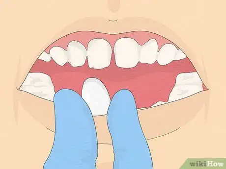 Image titled Fix Crooked Teeth Step 12