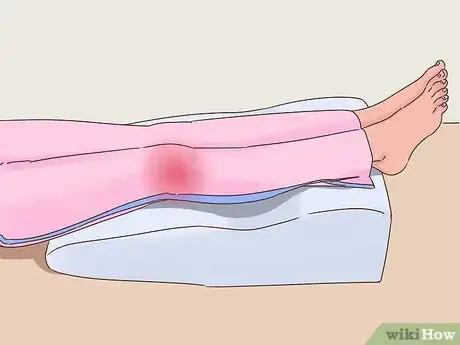 Image titled Get Rid of Bruises Step 2