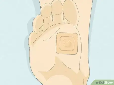 Image titled Get Rid of a Wart at the Bottom of Your Foot Step 4