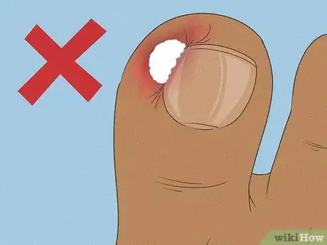 Image titled Will an Ingrown Toenail Heal Itself Step 6