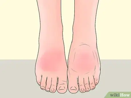 Image titled Check Feet for Complications of Diabetes Step 7