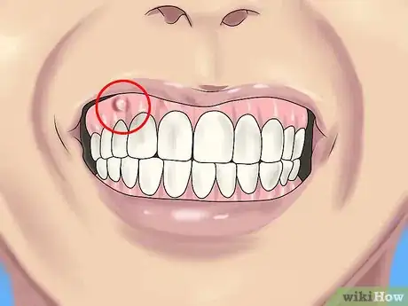 Image titled Reduce Jaw Pain Step 5
