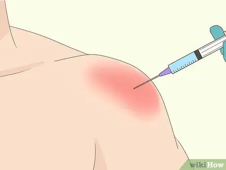 Image titled Treat Subacromial Bursitis Step 19