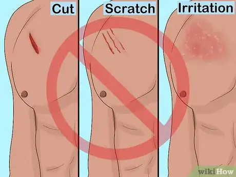 Image titled Apply a Fentanyl Patch Step 2