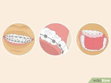 Image titled Fix Crooked Teeth Step 20