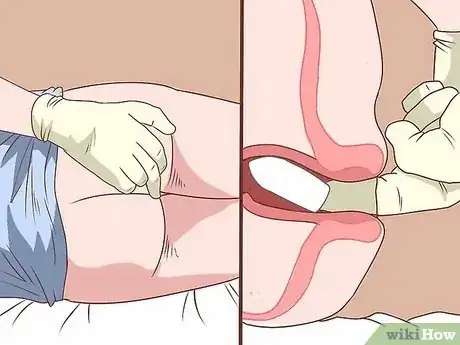 Image titled Give a Rectal Exam Step 6