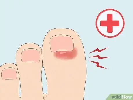 Image titled Protect Toenails when Running Step 12