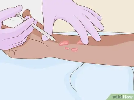 Image titled Get Rid of Keloids Step 3