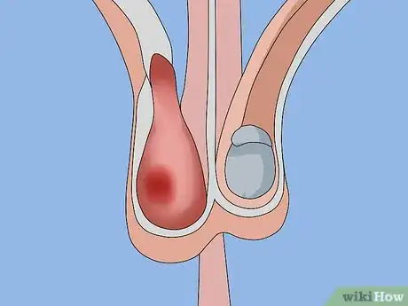 Image titled Recognize and Prevent Lymphatic Filariasis Step 3