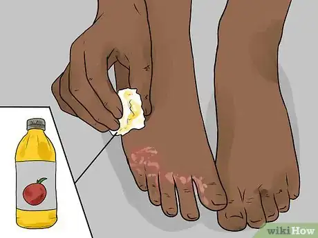 Image titled Use Apple Cider Vinegar for Athlete's Foot Step 6