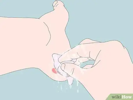 Image titled Treat a Blister on Your Heel Step 1