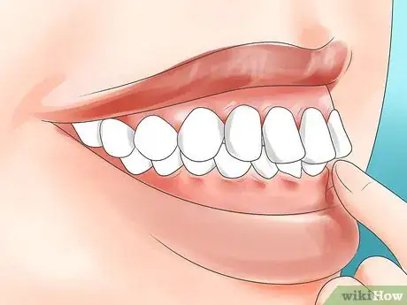 Image titled Determine if You Need Braces Step 4