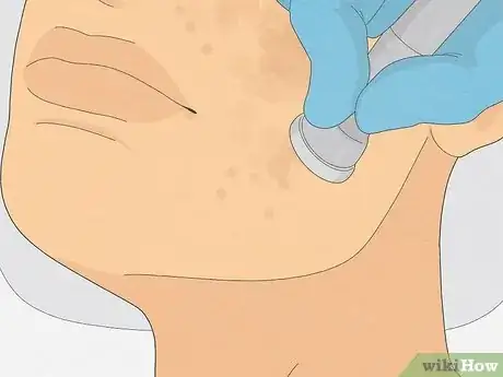 Image titled Get Rid of Cystic Acne Scars Step 10