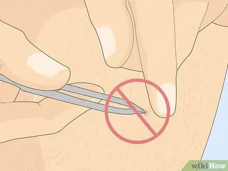 Image titled Remove an Ingrown Hair Under the Skin Step 9