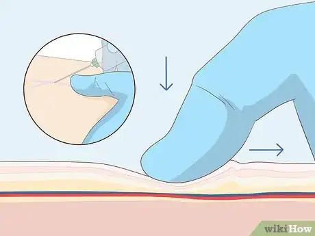 Image titled Troubleshoot a Difficult Venipuncture Step 4