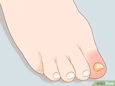 Image titled Treat a Swollen Toe Step 1