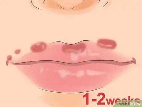 Image titled Test for Herpes Step 8